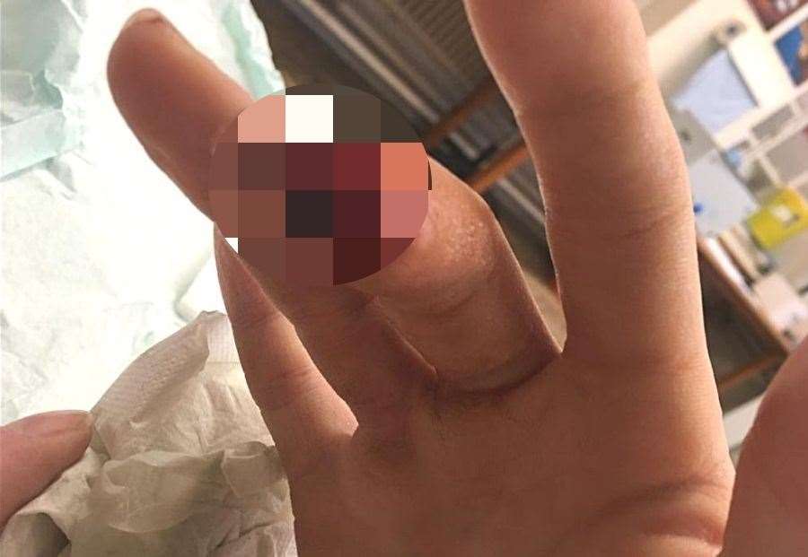Michael Connell had part of his finger bitten off, and it could not be reattached Picture: Neil Connell