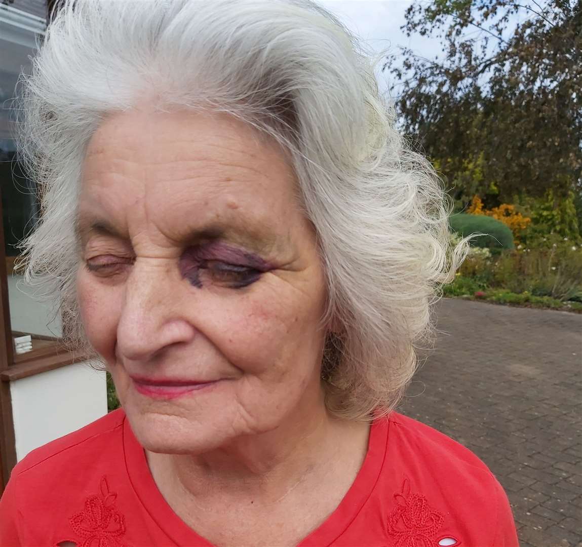 The bruise on Joan Stone's face where was she struck with a gun during a burglary