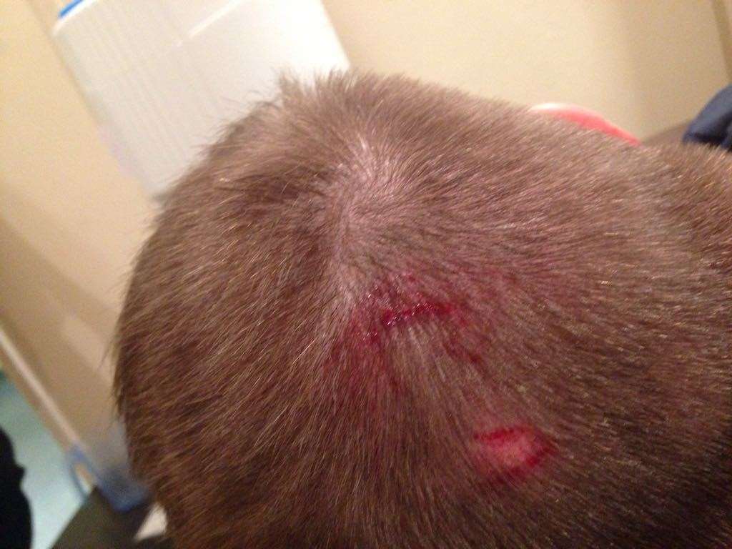 Injuries sustained by a victim of the Pelham Road attack, after being hit on the back of the head with a belt