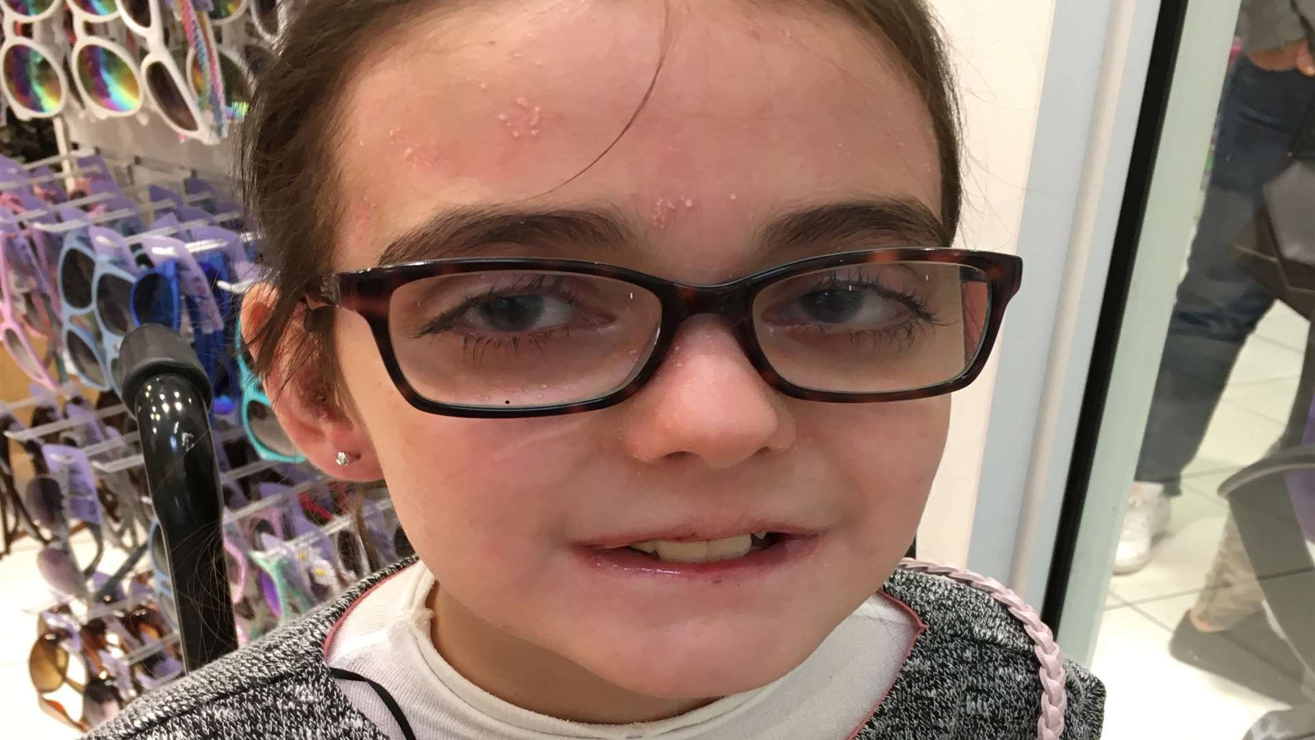 Ciara Hazel Paczensky has Epidermolysis Bullosa (EB), a genetic disorder which causes the skin to tear, rip and blister at the slightest touch