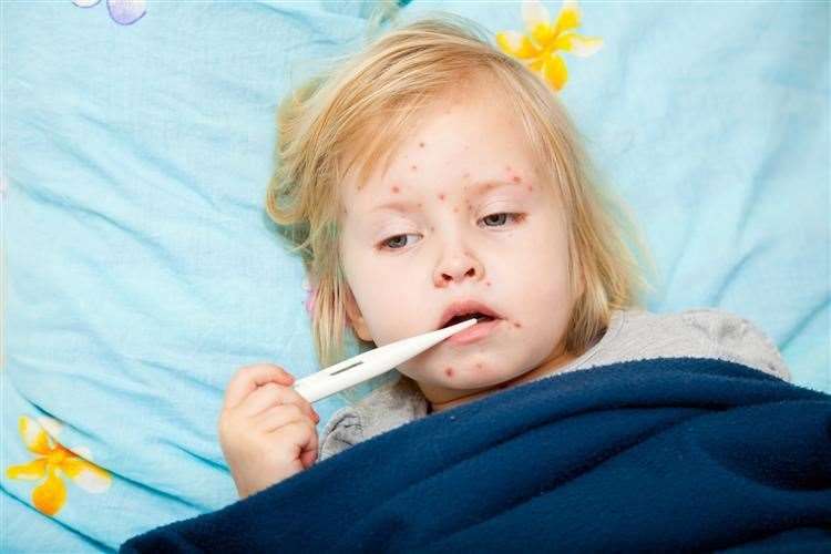 Measles symptoms include a blotchy red rash. Picture: Thinkstock.