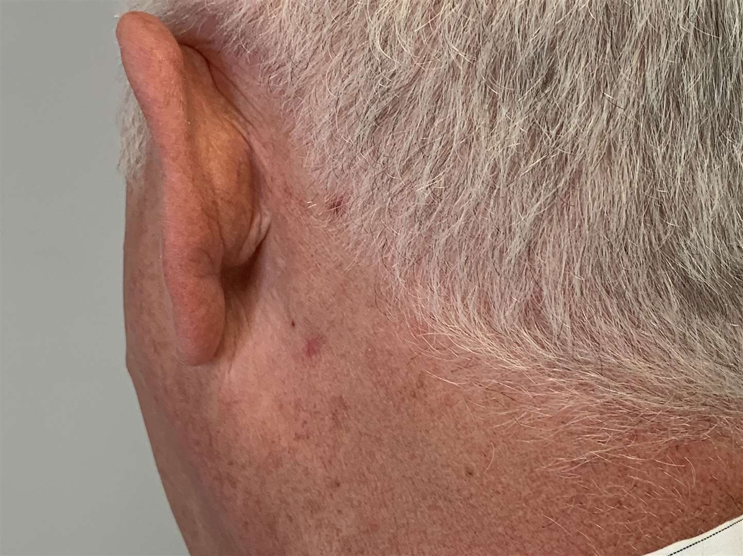 The mark on Derek's neck where a biopsy was taken for possible skin cancer (10737180)