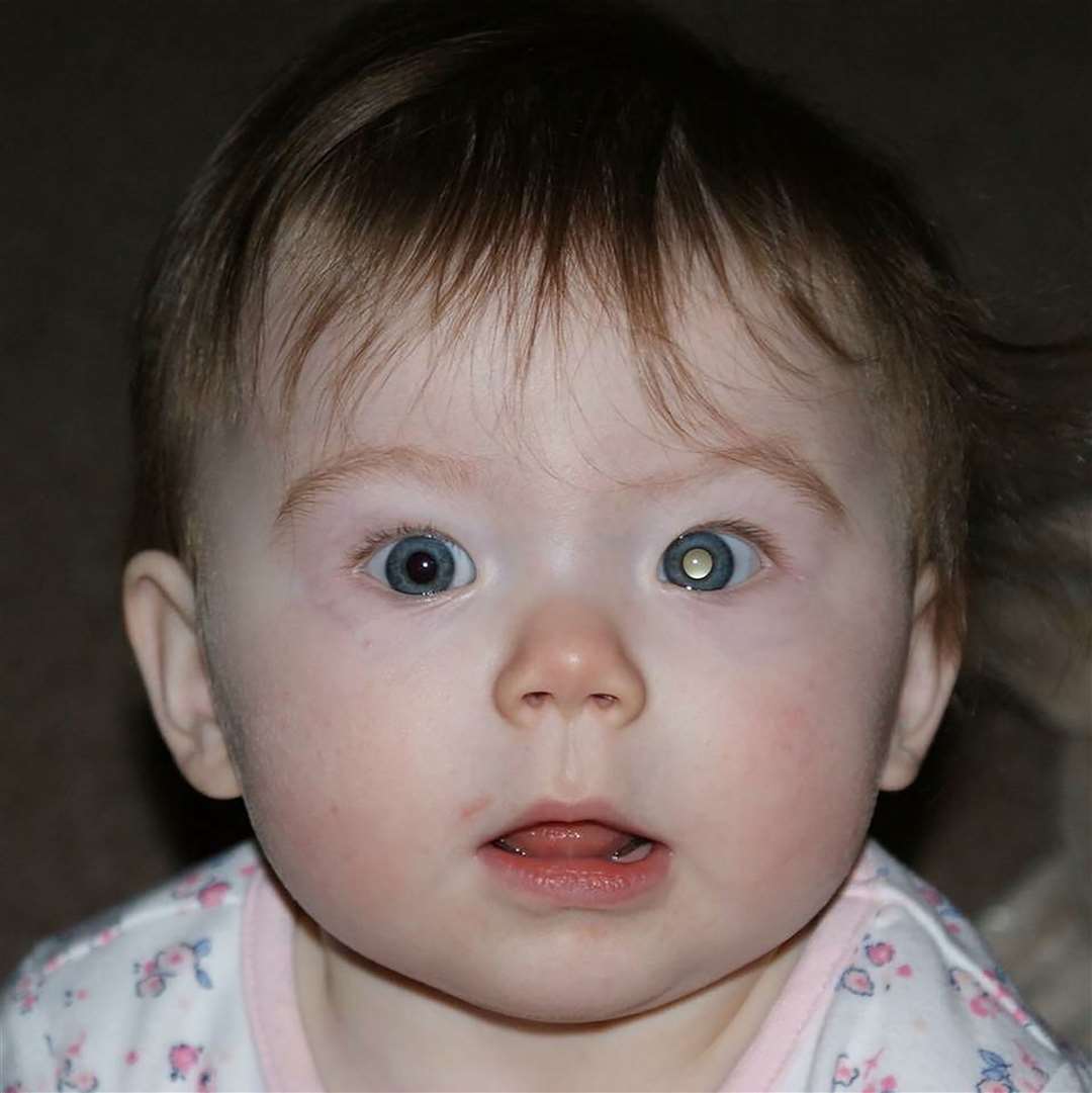 An example of a white glow in the eye symptomatic of retinoblastoma. Picture: CECT