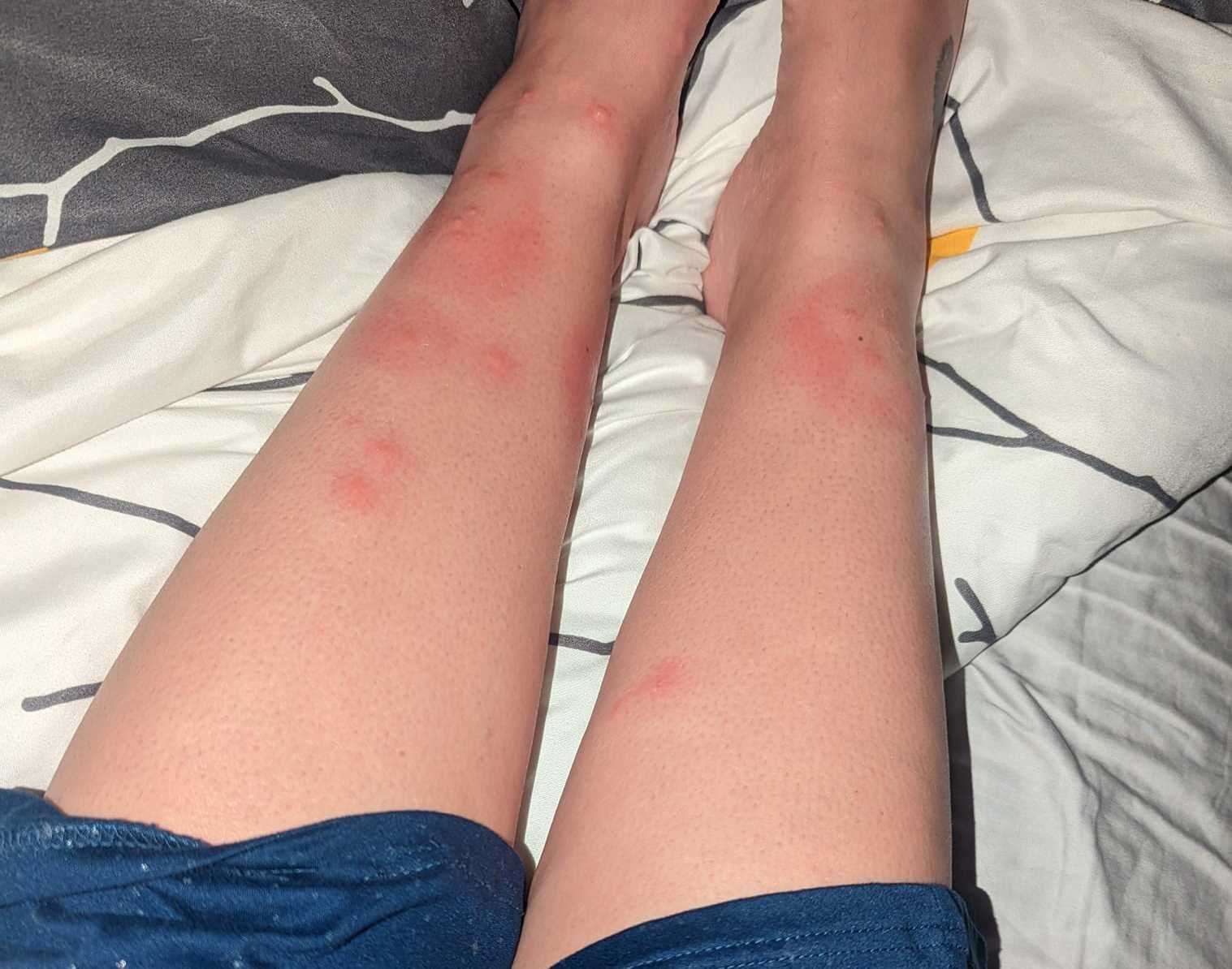 One mum watching her daughter play football in Sandwich shared a picture of her mosquito bites