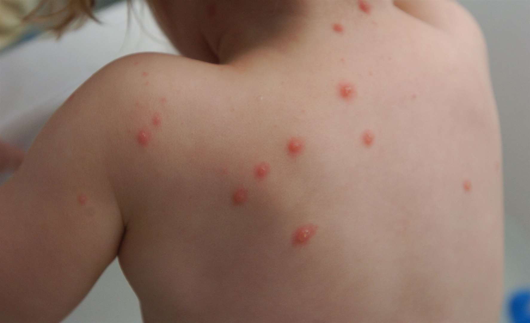 Most people catch chicken pox as a child, says the NHS