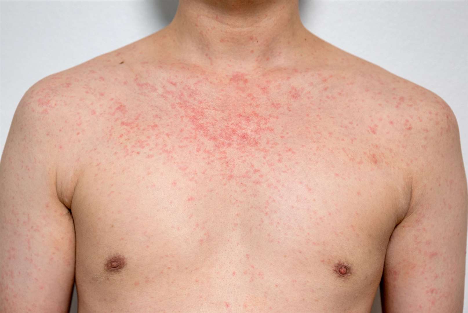 The UKHSA fears a measles outbreak. Image: iStock.