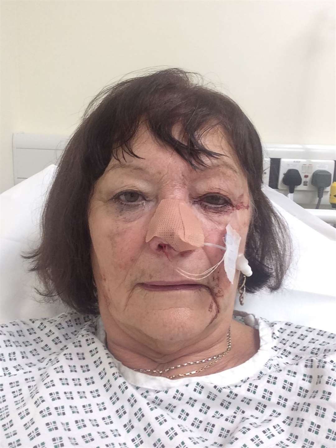 Joyce Green in hospital with a severe nose bleed