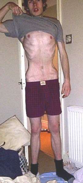 Steven Brazier at the height of his eating disorder