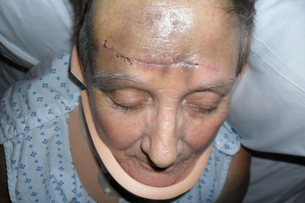 The stitches to Pat Ireland's forehead after she was in a head-on collision with Jonathan Ellis