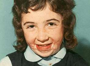 Jane as a child, following the accident. Picture: SWNS