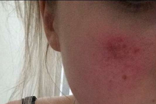 Mia Taylor suffered an injury to her cheek in the random attack