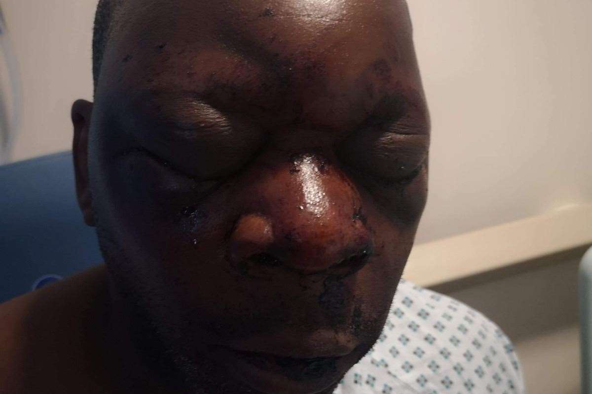 Etienne Bailey suffered extensive injuries following the horrific assault