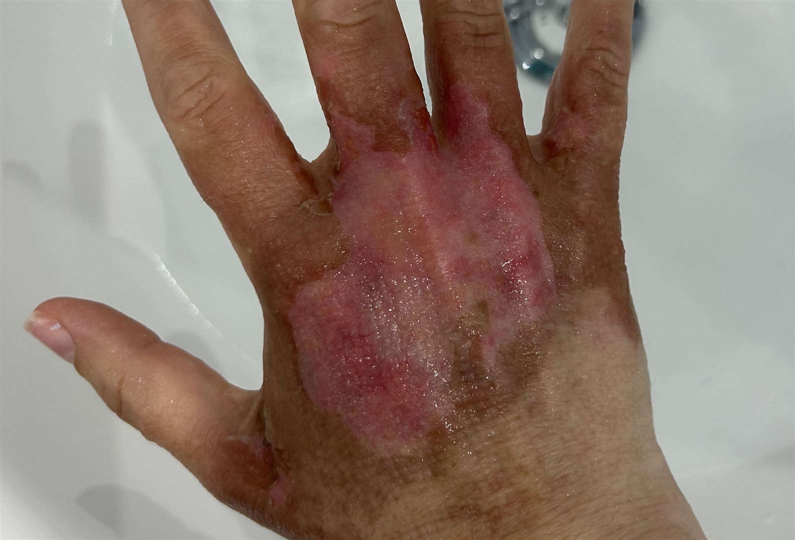 Lucy Jones had to have the blisters and skin scrapped off the top of her hand after getting a Hogsweed burn. Picture: Kennedy News
