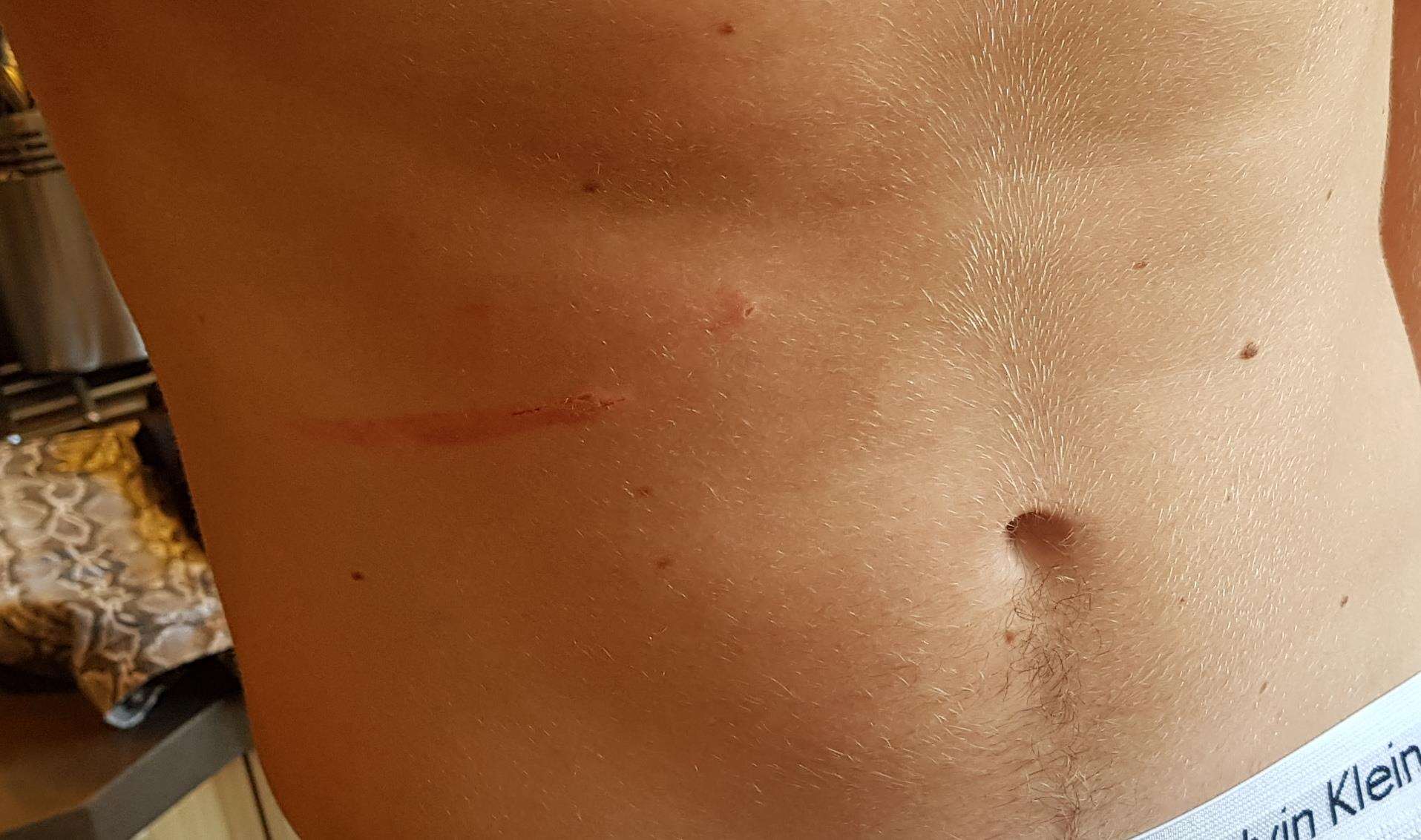 The teenager suffered a slash wound to his stomach