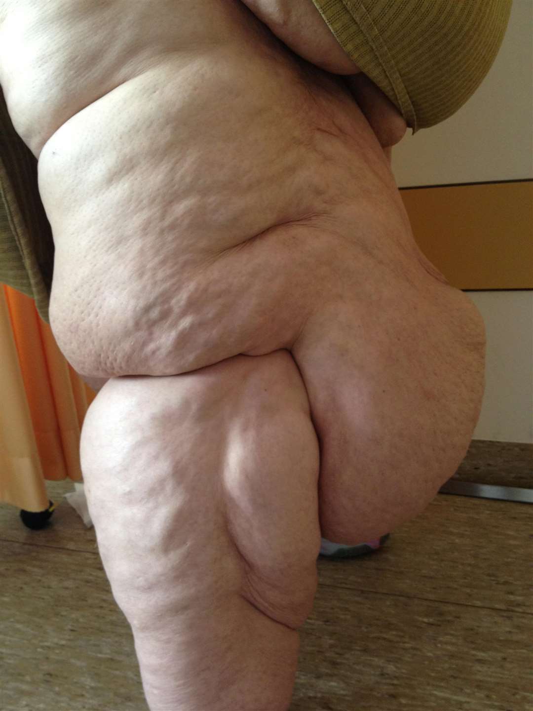 Lipodoema can be unsightly. This picture is of a leg of another patient. Picture: Herecomesdoc (2699857)