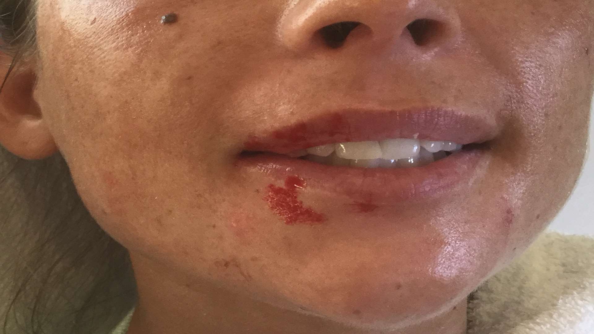 Blood around the mouth of the woman who left mid-treatment without paying