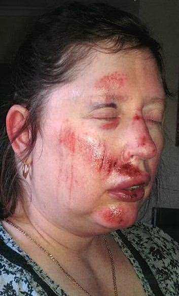 Mrs Gina had a cut above her eye, above her lip and on her face