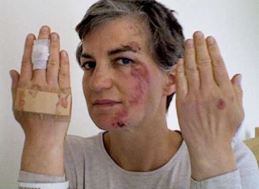 Clare Pryke shows her scarred face and bandaged hands which are still healing from the accident