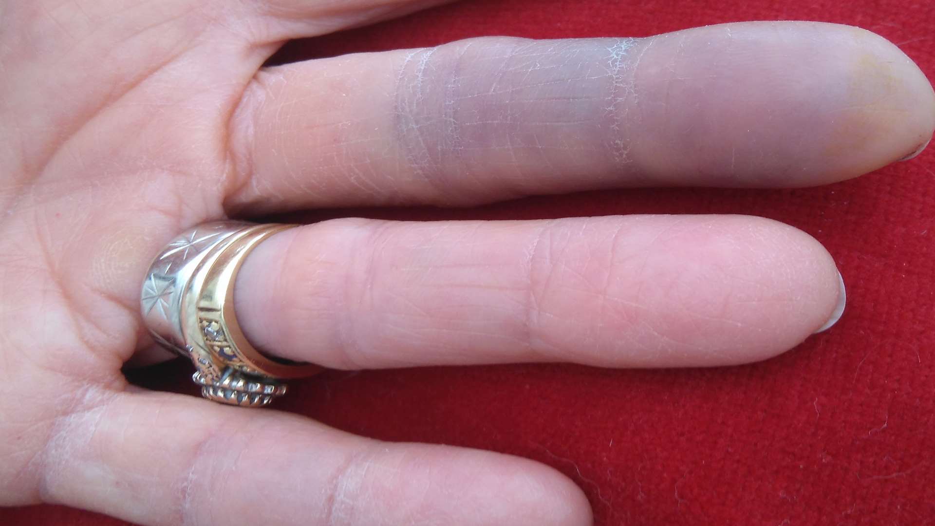 Patricia Tidbury's injured finger. Picture: John Westhrop