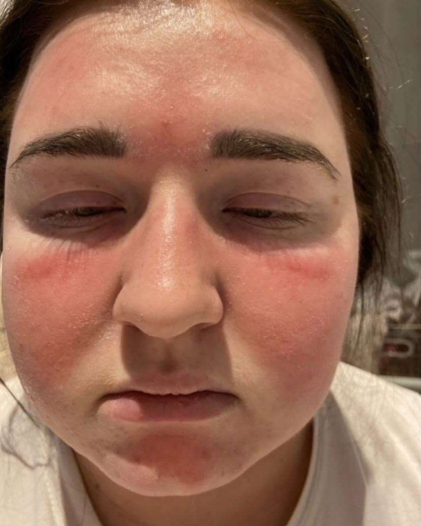 Millie Martin's swollen face caused by the condition. Picture: Millie Martin