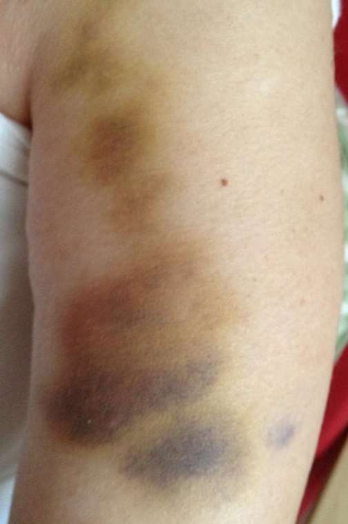 Lesley Thompson came home from her respite care centre with this bruise