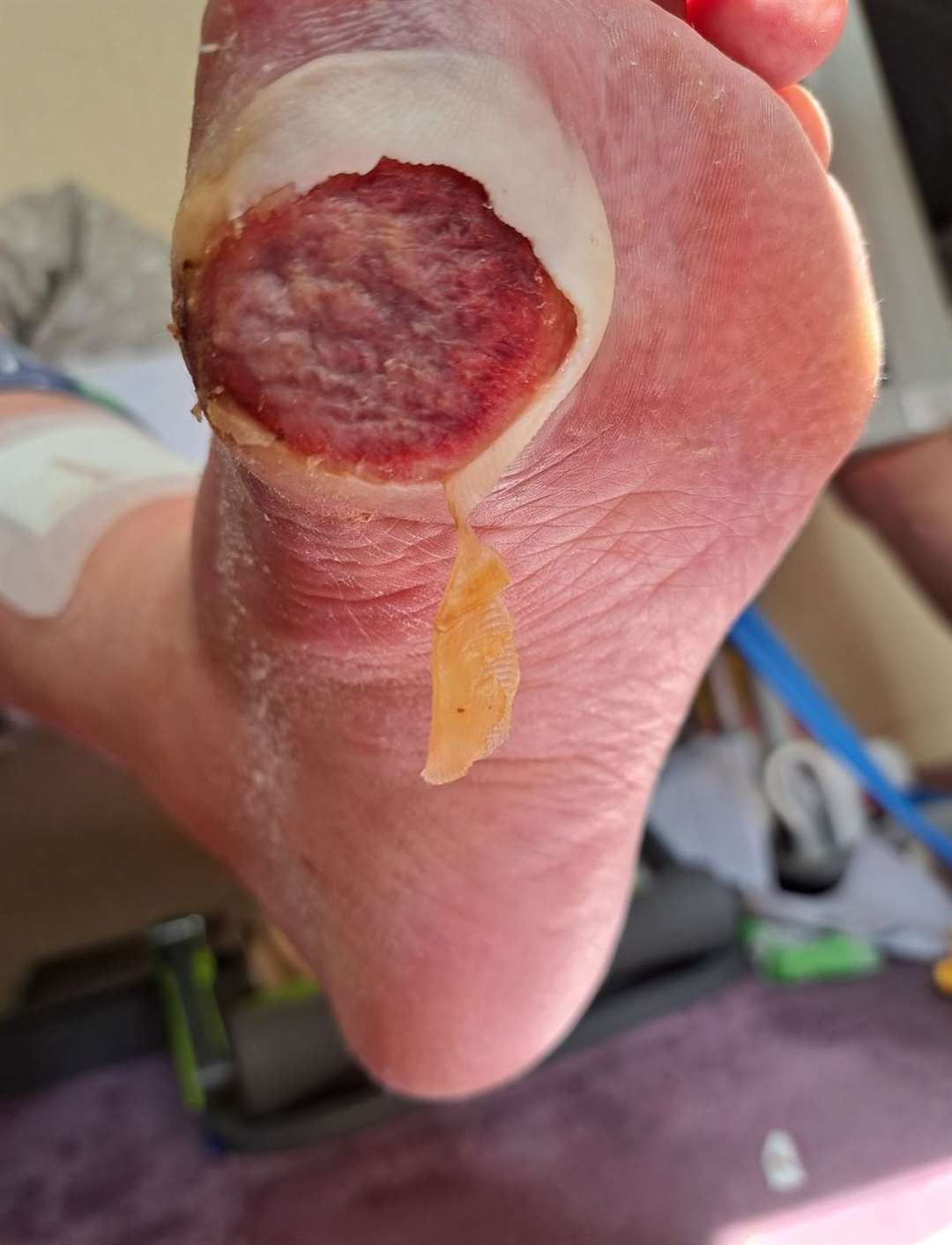 WARNING: Graphic image. The blister on Mrs Medhurst's foot, as captured by her granddaughter in July. Photo: Family release