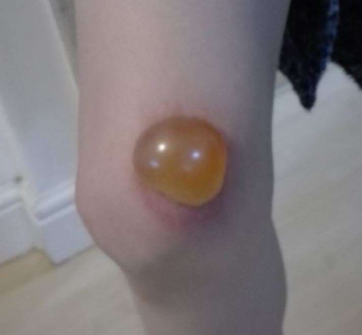 A blister caused by contact with Giant Hogweed