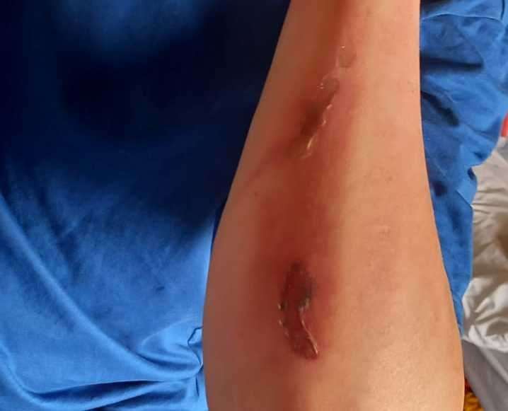 Burns and scars to Megan's husband Lee Holland's arm. Picture: Megan Holland