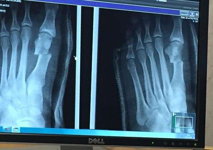 An xray scan taken 9 days after the initial surgery showing the dislodged bone