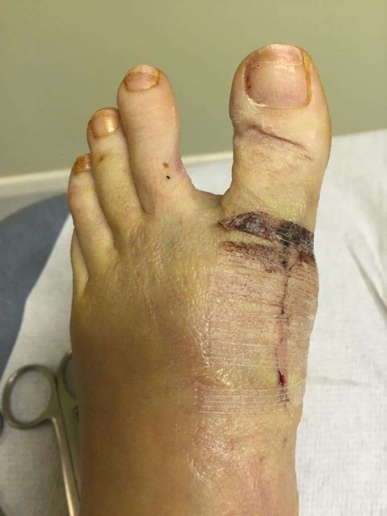 Mrs Gurnham's foot following the surgery she says was undertaken by Dr Sait