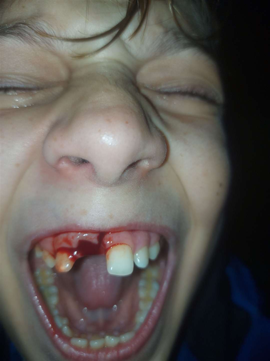 Denis-Cristian Bulancea, 12, with his missing front tooth after having it ripped out on a children's castle slide at Beachfields, Sheerness. Picture: Dumitru-Daniel Bulancea