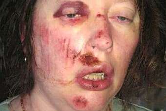 Mrs Gina sustained nasty cuts and bruises to her face