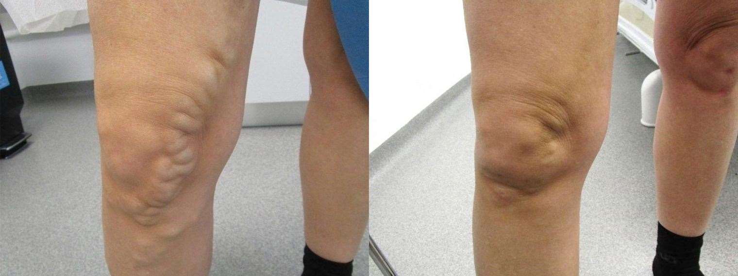 Before and after: The treatment is a simple one-hour using a minimally invasive laser therapy procedure at Bella Vou called Endovenous thermal ablation.