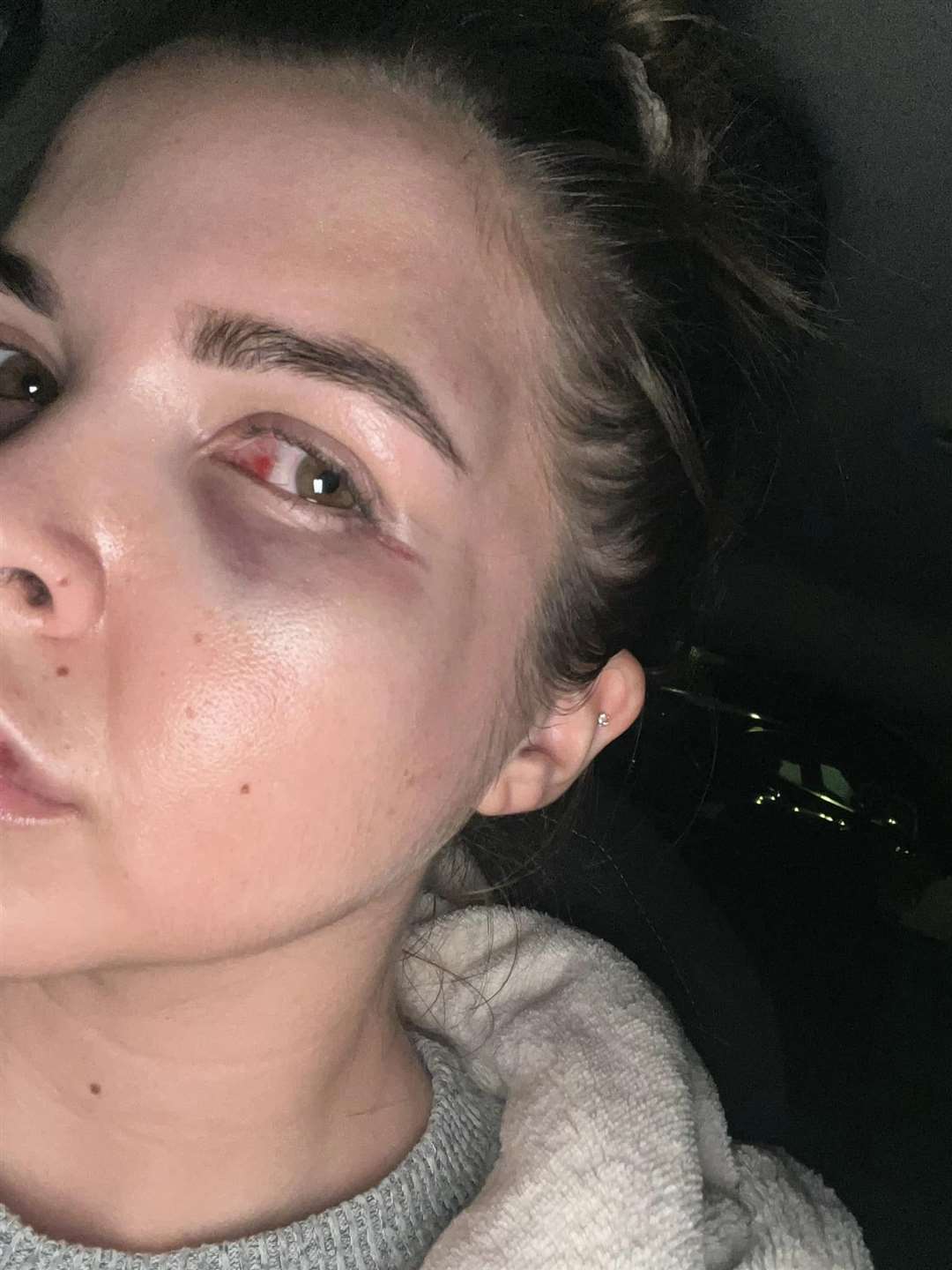 She was assaulted during a night out at Casino Rooms Nightclub, Rochester. Picture: Nadia Zuccarello