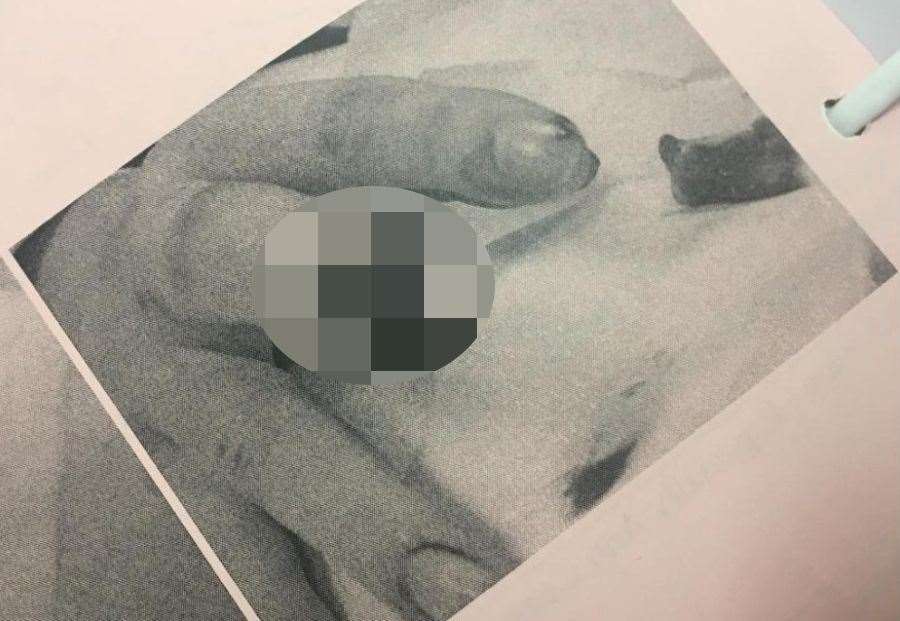 Michael Connell had part of his finger bitten off, and it could not be reattached Picture: Neil Connell