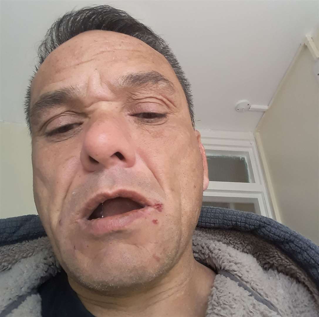 Russell Davies, 55, has been bitten all over his body, including his lips. Picture: Russell Davies