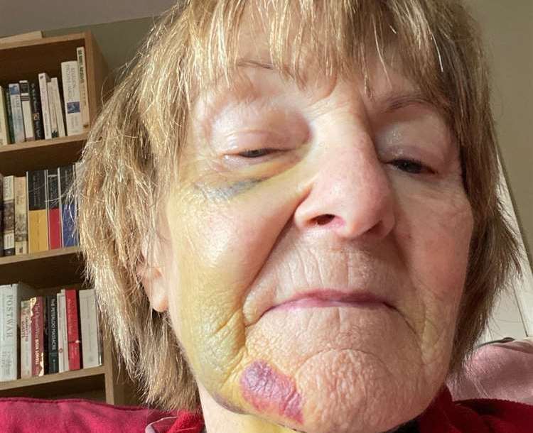 Pictures show the extent of Sarah Carter’s facial injuries