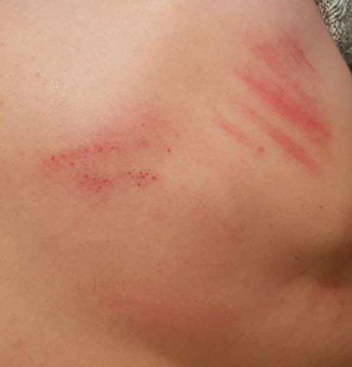 One of the boys was left with marks on his back. (6179950)