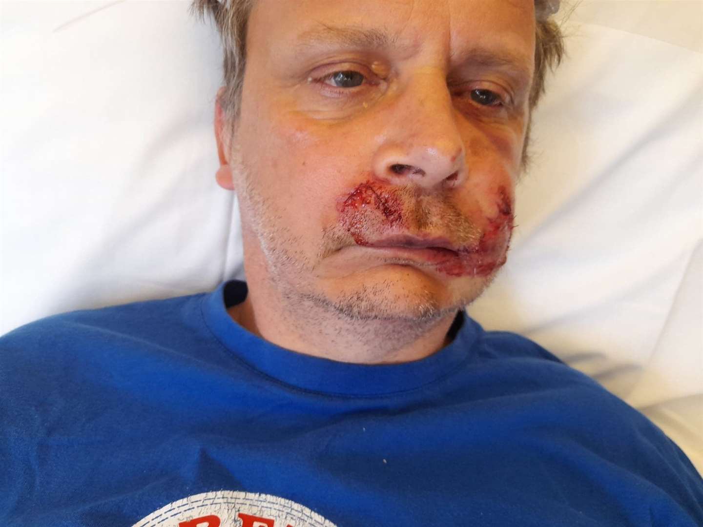 Steve was in hospital for five days following the attack. Picture: Steve Rowe