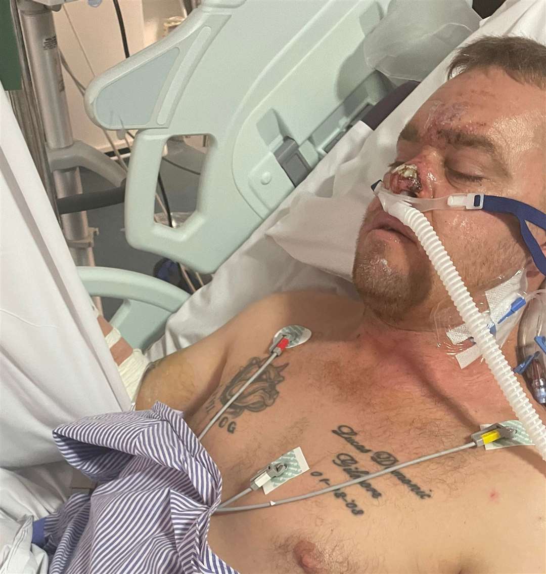 Scaffolder Steven Gilmore remains in London hospital. Picture: Vicky Blackman