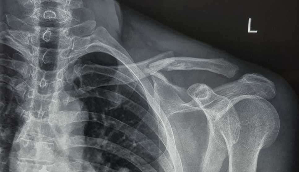 He broke his left collar bone in the nasty crash. Picture: Jonathan Parker (10287936)