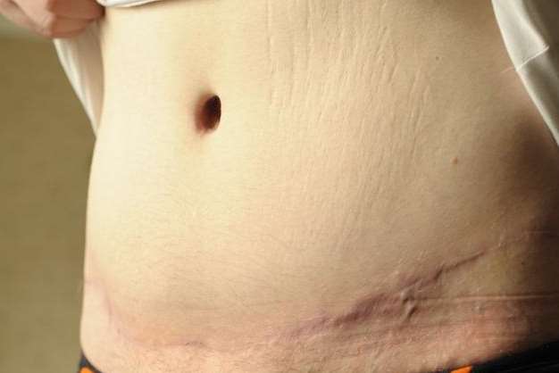 The tummy tuck has left just a faded scar
