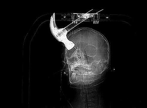 An X-ray of the hammer embedded in Connor Huntley's skull