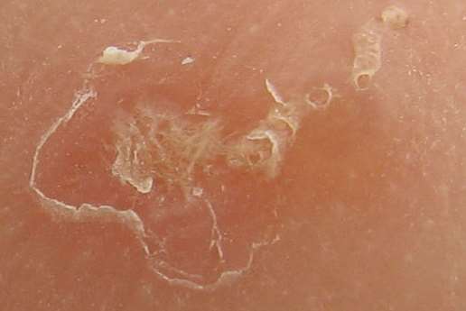 Close-up of a scabies burrow. The large scaly patch at the left is due to scratching. Picture: Michael Geary