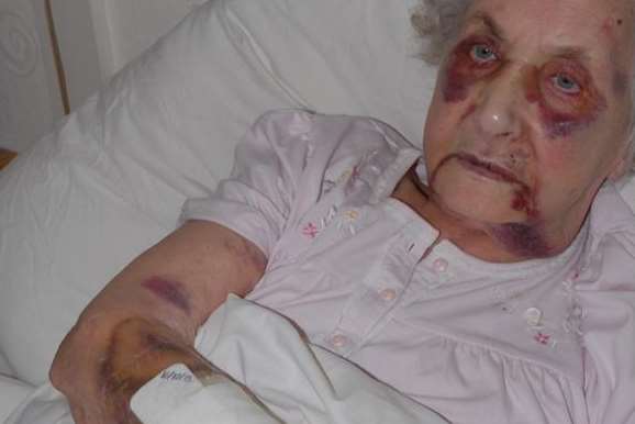 Victim Jean McDougall suffered a broken nose and eye socket, a fracture to the base of her spine and other injuries