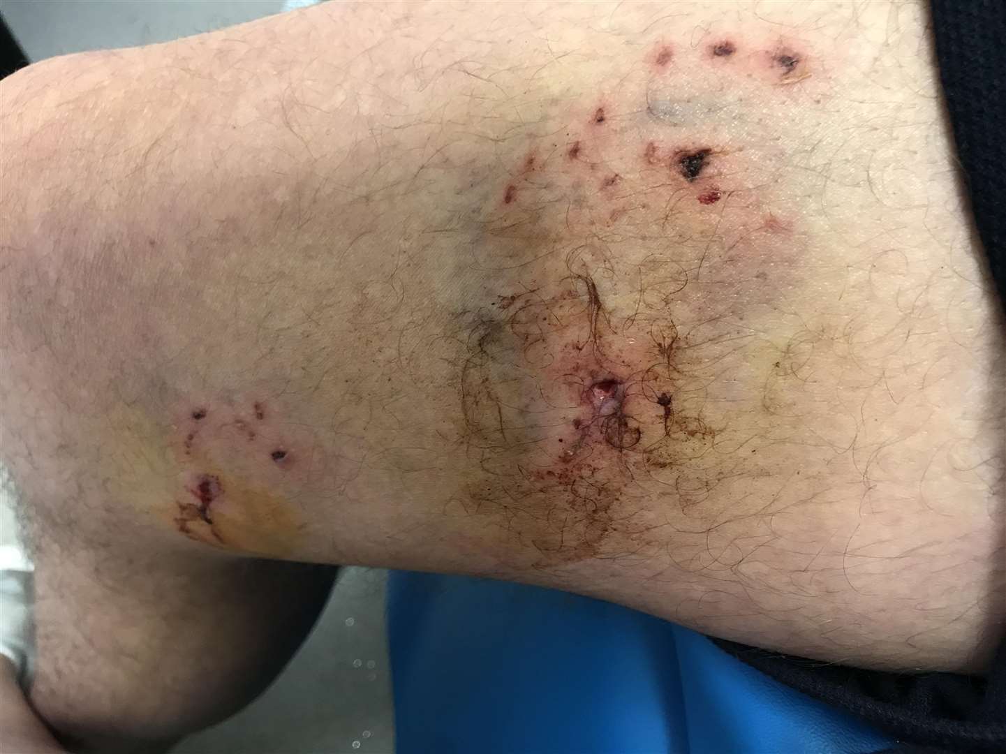 David Turner was bitten on the hand and leg during a vicious attack in Sevenoaks