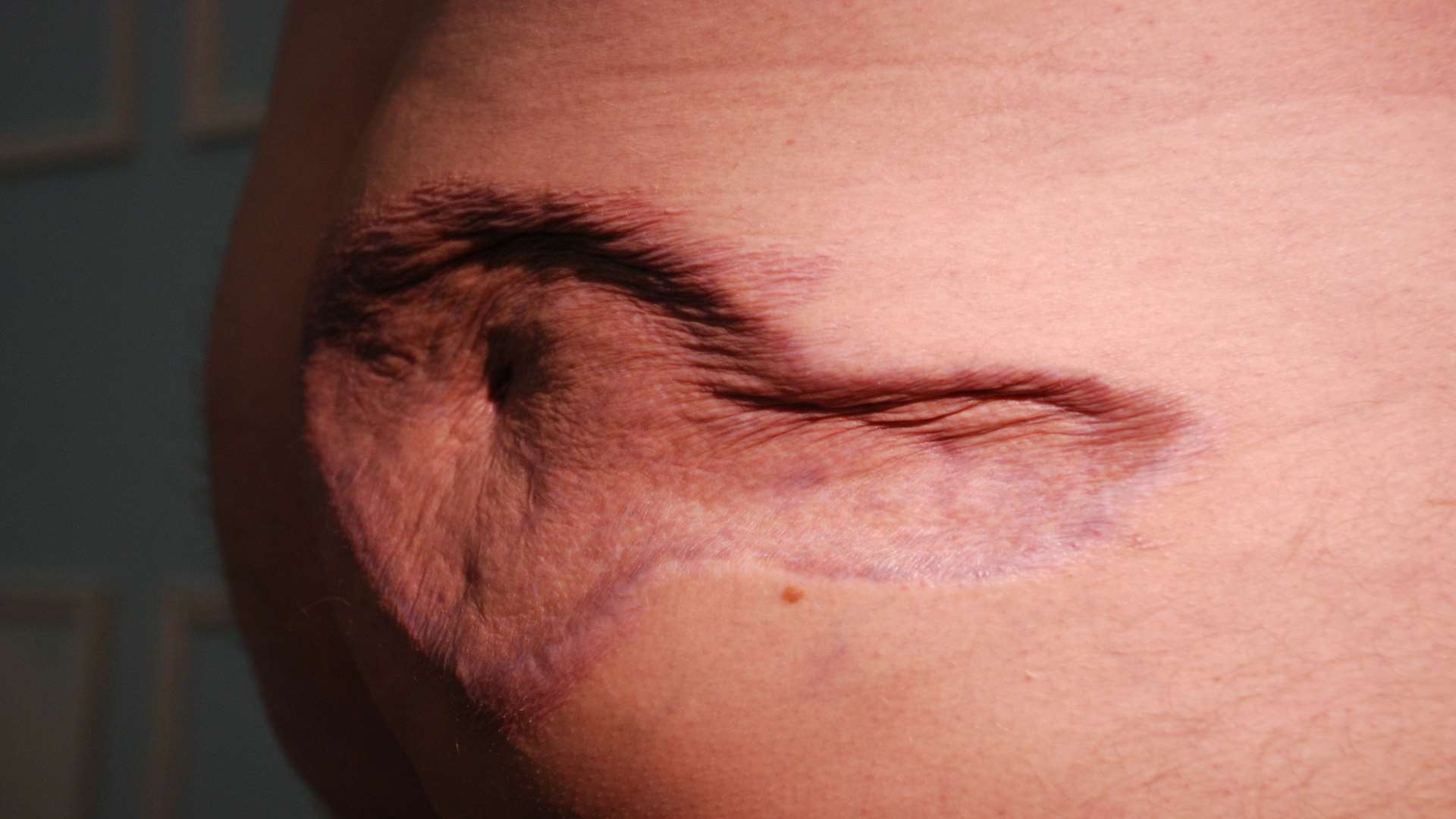 The scar as it looks today