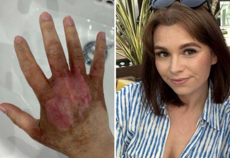 Maidstone mum forced to cut Spanish holiday short after suffering ‘agonising’ Hogsweed burn