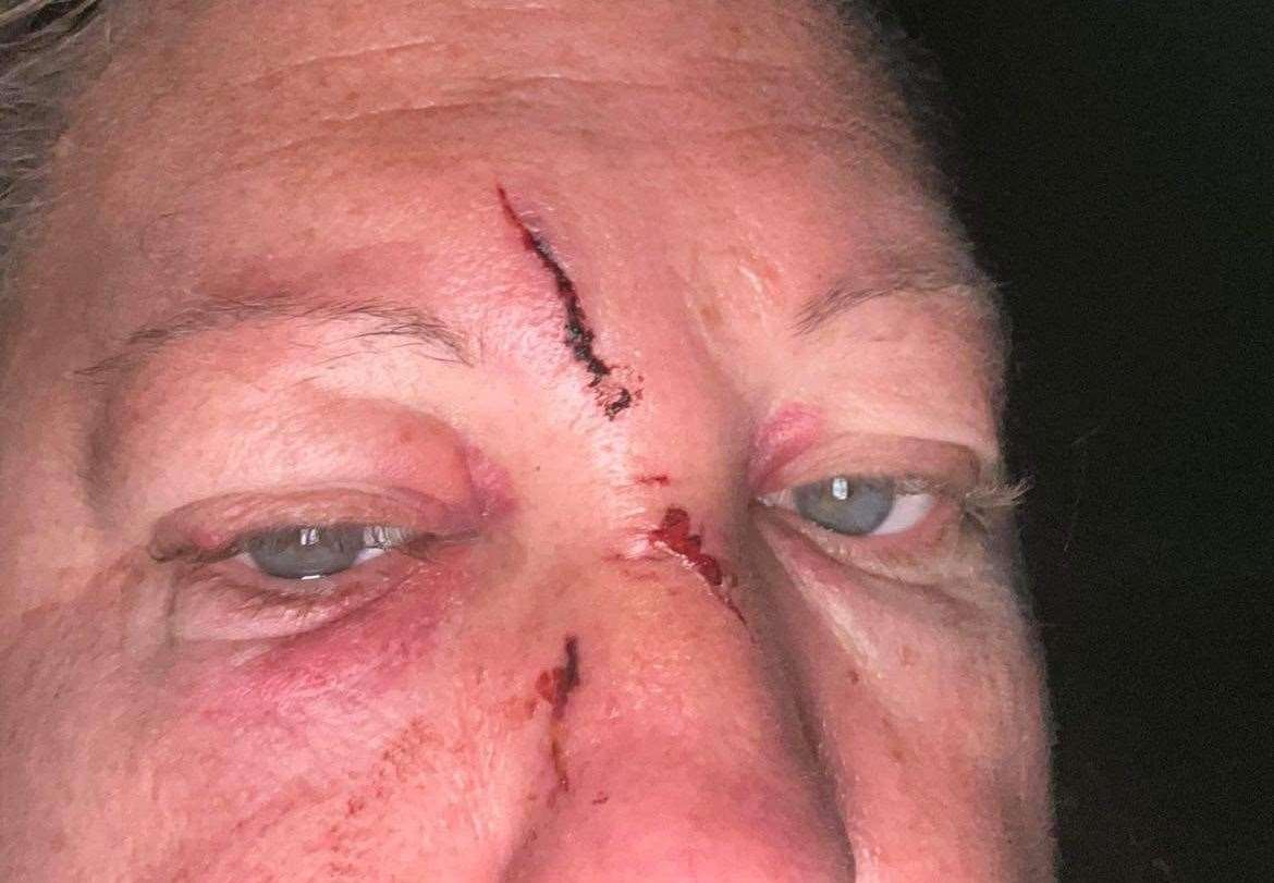 Zoe Jennings was left with a broken nose after she was assaulted by Barry Connaughton in Chatham. Picture: Zoe Jennings