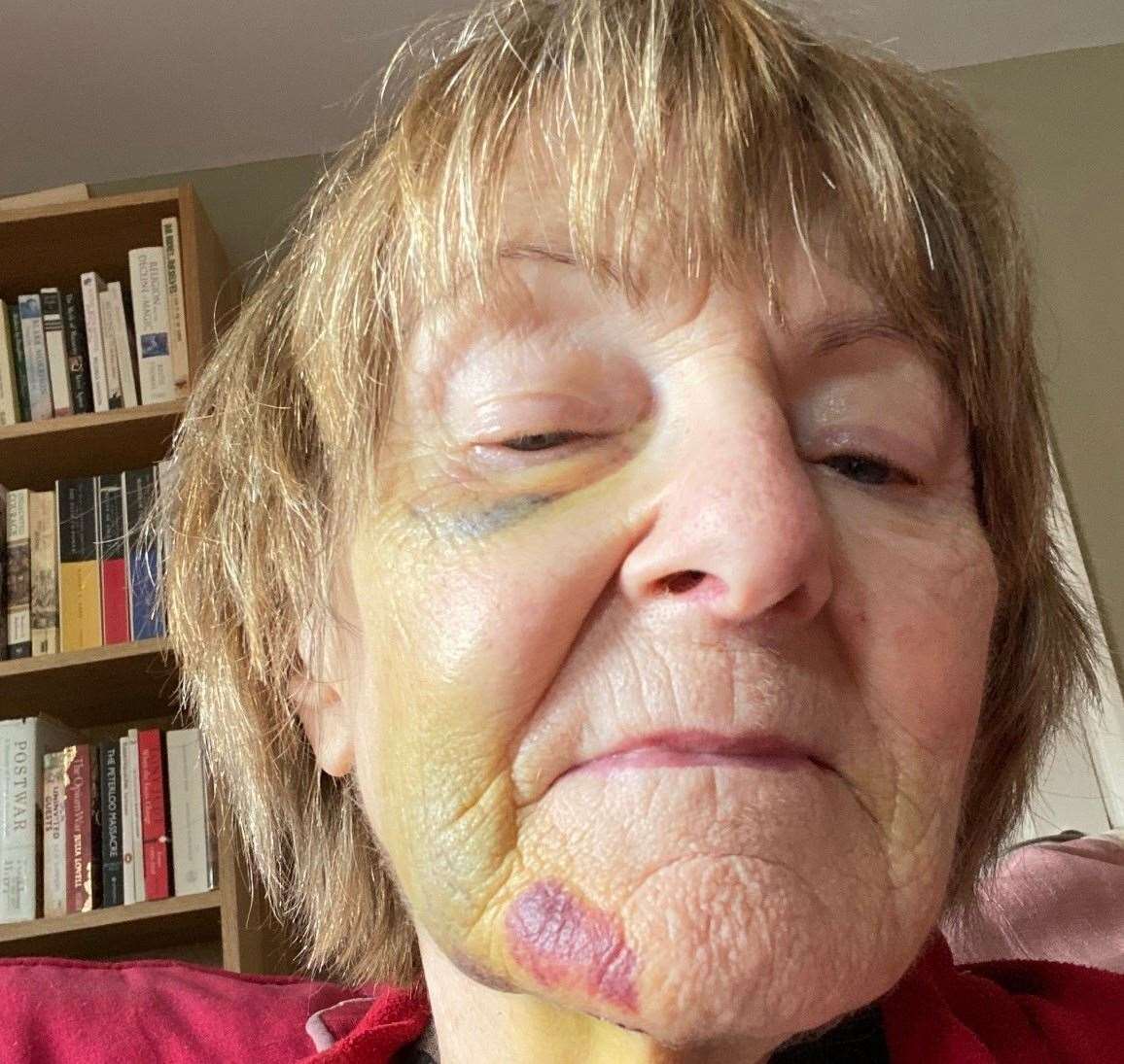 Sarah Carter's facial injuries after she was hit by an e scooter in Canterbury. Picture: Sarah Carter
